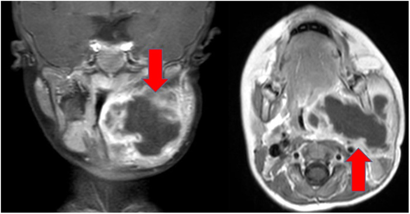 Peritonsillar abscess in children: A retrospective analysis on surgical and antimicrobial approaches.