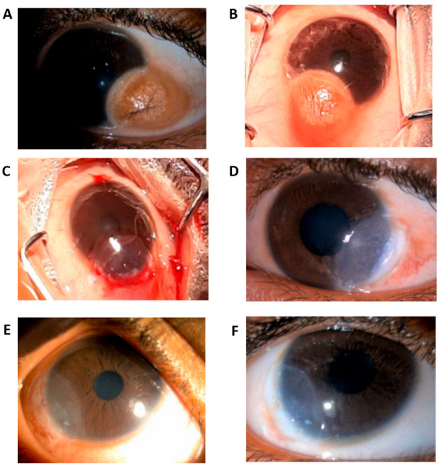 Novel Surgical Approach for Limbal Dermoid Excision: Utilizing Bowman's Membrane Lenticule and Autologous Limbal Stem Cell Transplantation for Enhanced Epithelial Healing and Visual Outcomes.