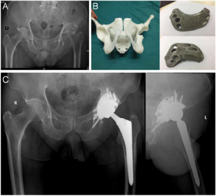 Custom 3D-printed porous titanium augments for Paprosky type III acetabular defects: a case series combining biomechanical rationale with early clinical outcomes.