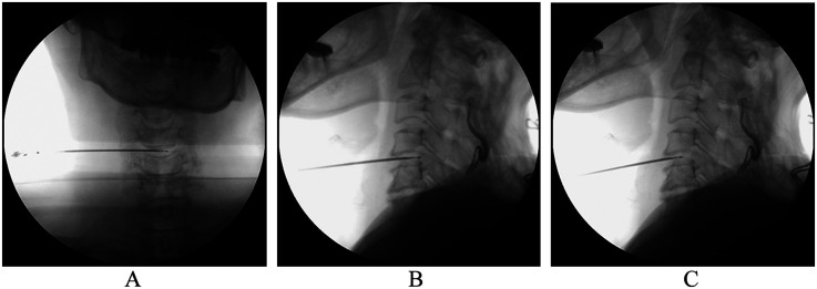 Clinical and radiological comparison of percutaneous cervical nucleoplasty combined with ultrasound-guided pulsed radiofrequency of cervical nerve root for cervical radicular pain: a retrospective, matched-cohort study.