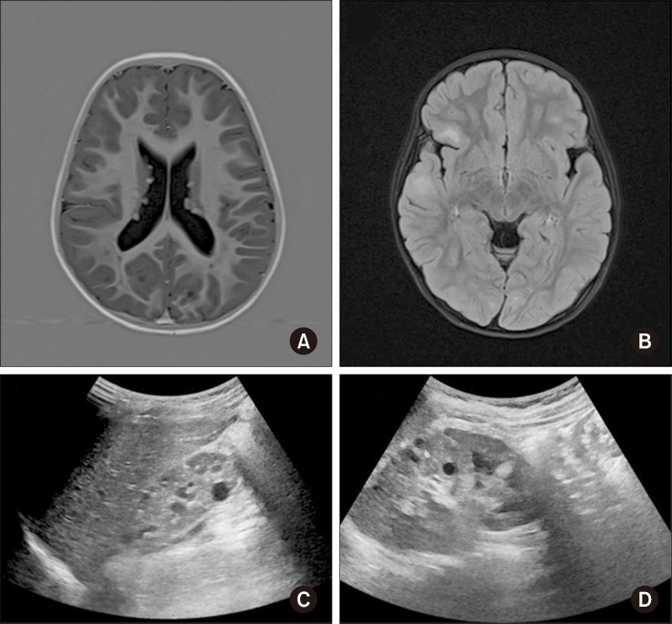 Tuberous Sclerosis Complex Caused by <i>TSC2</i> Inversion and Deletions Identified Using Whole-genome Sequencing: A Case Study.