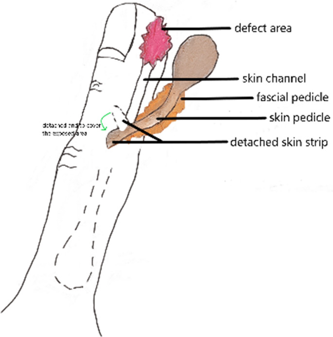 Skin pedicle expansion technique in dorsal nerve fascial Island flap: enhancing viability in repairing digital soft tissue defects.