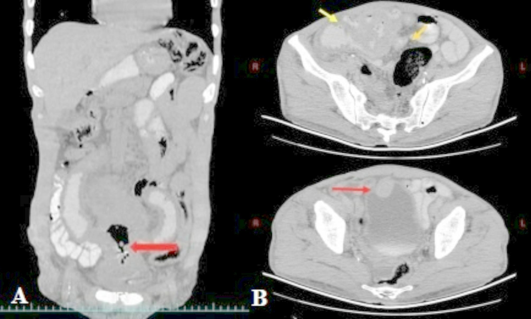 Enterovesical fistula in chronic lymphocytic leukemia transforming to Richter syndrome: a case report and literature review.