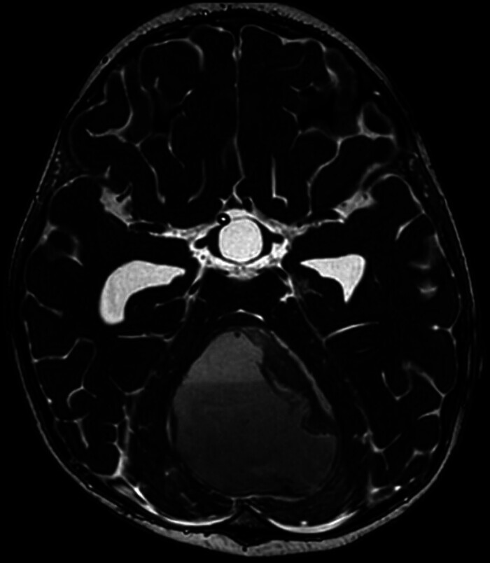 Extremely Rare Presentation of Pilonidal Sinus Disease in the Posterior Cranial Fossa of a 2-Year-Old Patient: A Case Report.