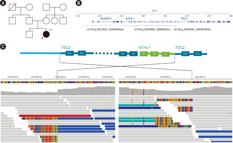 Tuberous Sclerosis Complex Caused by <i>TSC2</i> Inversion and Deletions Identified Using Whole-genome Sequencing: A Case Study.