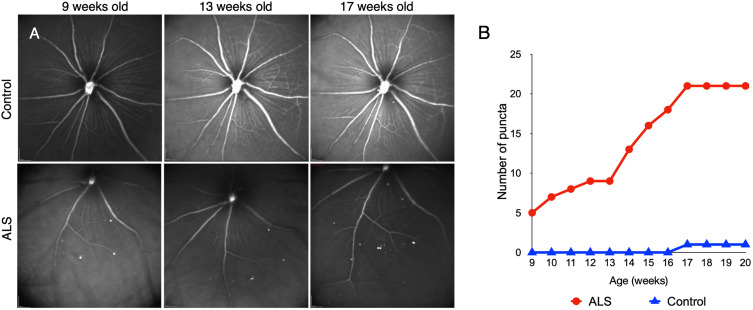 A Novel Retinal Nerve Fiber Layer Biomarker of Amyotrophic Lateral Sclerosis (ALS) Identified Using Longitudinal in vivo Ocular Imaging.