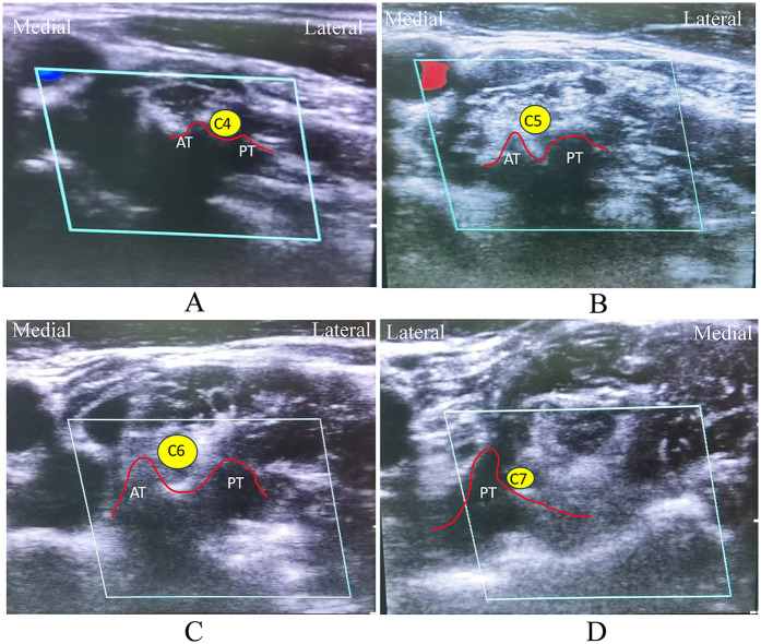 Clinical and radiological comparison of percutaneous cervical nucleoplasty combined with ultrasound-guided pulsed radiofrequency of cervical nerve root for cervical radicular pain: a retrospective, matched-cohort study.