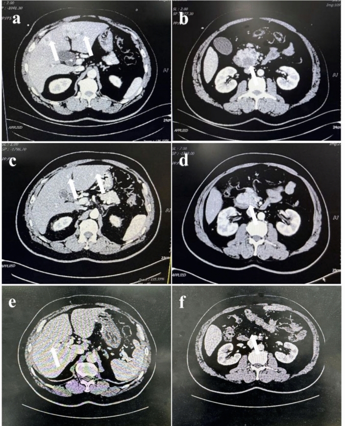 Conversion therapy and R0 resection for pancreatic cancer with multiple liver metastases: a case report.