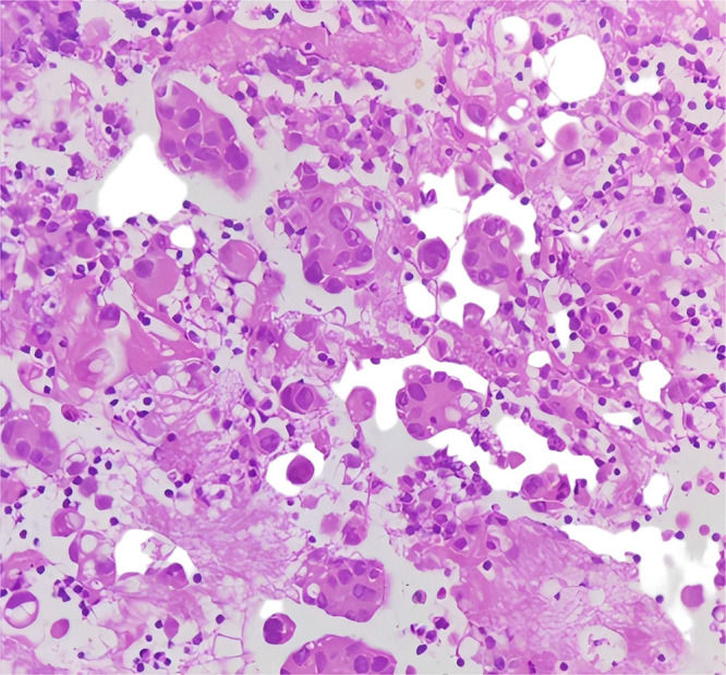 Integrated Traditional Chinese and Western Medicine in Lung Adenocarcinoma with Rare EGFR Mutation and Nephrotic Syndrome: A Case Report.