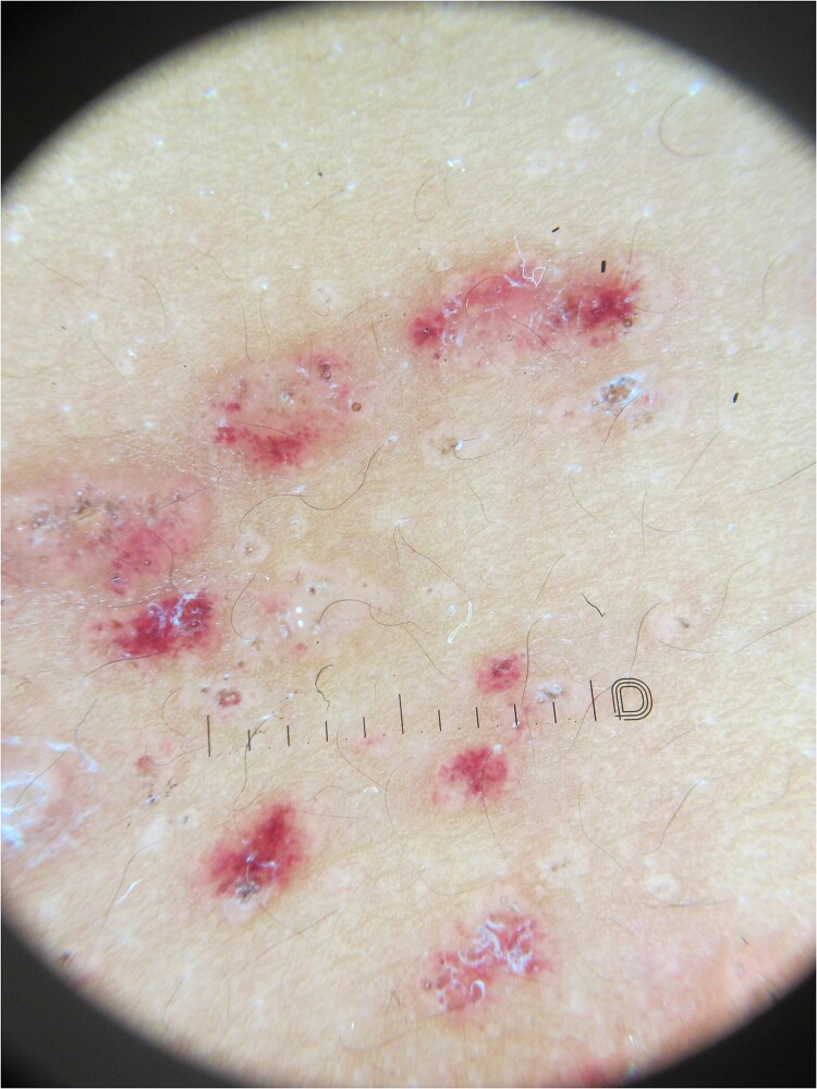Langerhans cell histiocytosis disguised as lichenoid eruption.