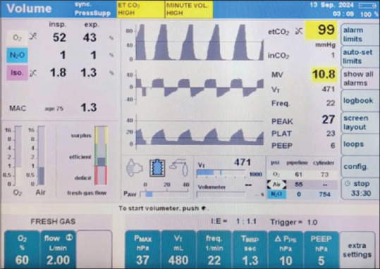 End-Tidal Carbon Dioxide - A Guided Tool to Diagnose a Bronchial Tree Injury in Thoracoscopic Procedures.