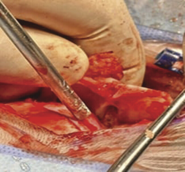 Extremely Rare Presentation of Pilonidal Sinus Disease in the Posterior Cranial Fossa of a 2-Year-Old Patient: A Case Report.
