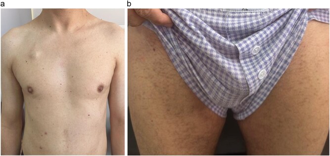 When Pityriasis Versicolor wears a vitiligo mask: a puzzle in an immunocompromised patient.