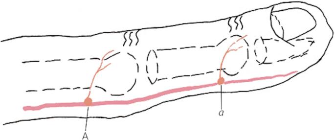 Skin pedicle expansion technique in dorsal nerve fascial Island flap: enhancing viability in repairing digital soft tissue defects.