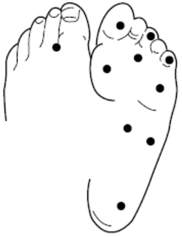 Improvement in Protective Sensation: Clinical Evidence From a Randomized Controlled Trial for Treatment of Painful Diabetic Neuropathy With 10 kHz Spinal Cord Stimulation.
