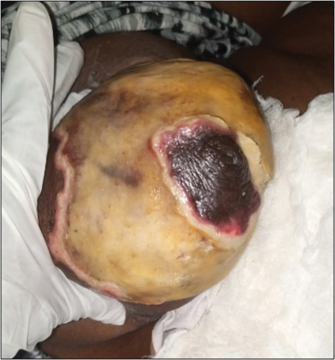 Primary Breast Necrotising Fasciitis in an Elderly Woman Managed with Nipple-Areola Conservation and Delayed Primary Closure in a Resource-Poor Setting A Case Report.