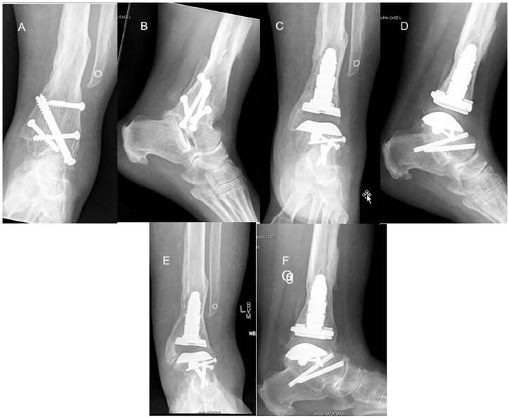 Midterm Outcomes Following Conversion of Failed Ankle Arthrodesis to Total Ankle Arthroplasty, Including Patients With a Deficient Fibula.