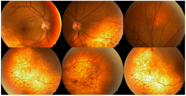 Bilateral Diffuse Uveal Melanocytic Proliferation in a Patient with Chronic Myelomonocytic Leukemia: A Rare Case and Literature Review.