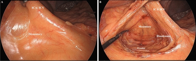 Inferior versus medial approach in laparoscopic and robotic surgery with complete mesocolic excision for right-sided colon cancer: propensity score-matched analysis.