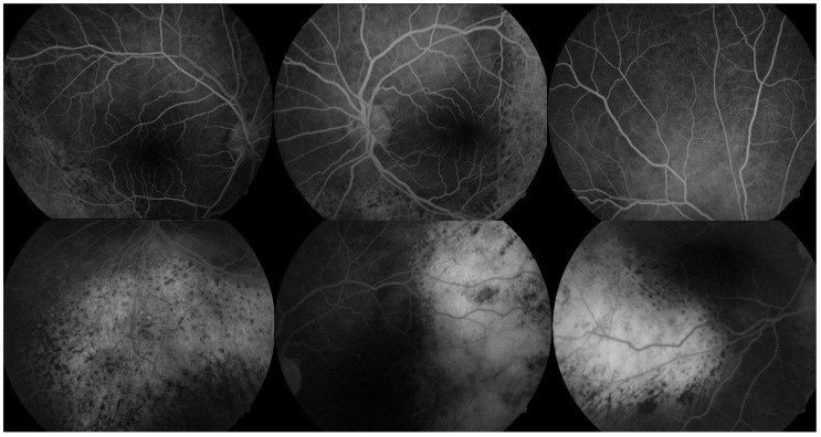Bilateral Diffuse Uveal Melanocytic Proliferation in a Patient with Chronic Myelomonocytic Leukemia: A Rare Case and Literature Review.