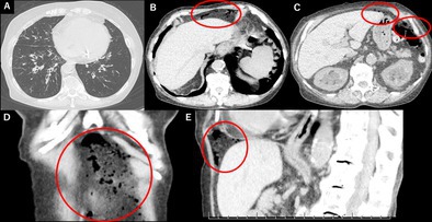 Nonsurgical Pneumoperitoneum: A Rare Thoracoabdominal Complication of Asthma Exacerbation.