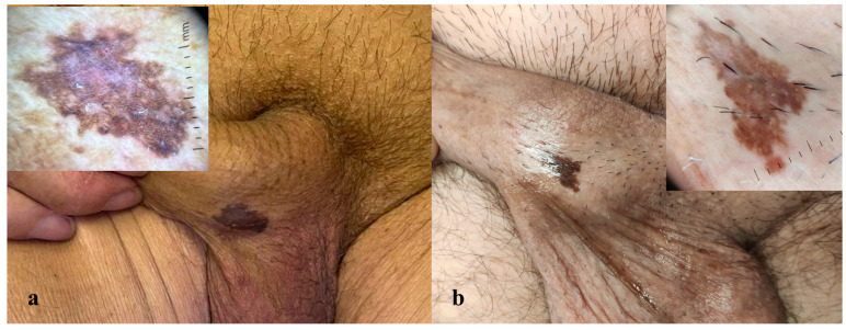 Non-Invasive Diagnostic Techniques in Penile Intraepithelial Neoplasia (PeIN): Insights from Reflectance Confocal Microscopy (RCM), Line-Field Confocal Optical Coherence Tomography (LC-OCT), and Correlation with Histopathological Features.