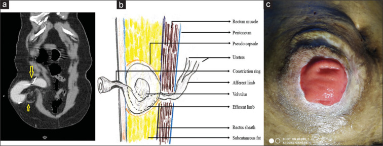 Volvulus of segment of ileal conduit anterior to the rectus sheath presenting as acute urinary retention.