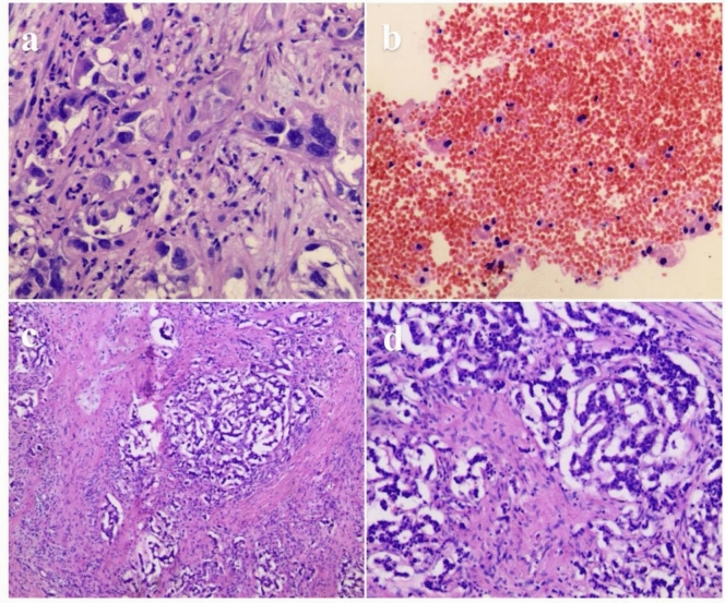 Conversion therapy and R0 resection for pancreatic cancer with multiple liver metastases: a case report.