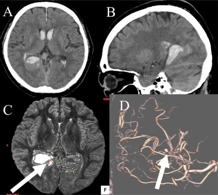 A case of intracranial hemorrhage due to rupture of aneurysm of the distal posterior cerebral artery associated with dural arteriovenous fistulas of the falcine sinus.