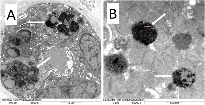 Case Report: Toxic tubulointerstitial nephropathy with lipofuscin deposition - the potential cause of occupational Bisphenol-A exposition.