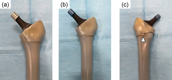 Biomechanical comparison of cemented versus cementless fixation in intraoperative femoral fractures during total hip arthroplasty.