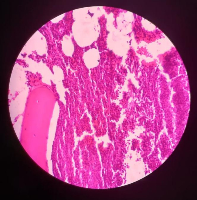Enterovesical fistula in chronic lymphocytic leukemia transforming to Richter syndrome: a case report and literature review.
