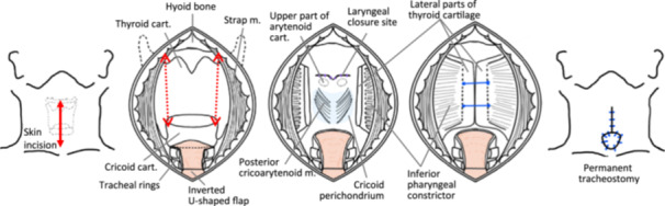 Improved Pharyngeal Contraction and Oral Intake Status After Modified Central-Part Laryngectomy for Late-Stage ALS.