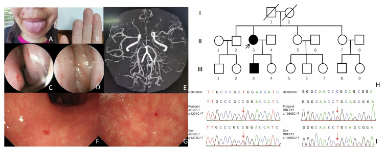 Coexistence of Hereditary Hemorrhagic Telangiectasia and Moyamoya Disease: A Case Report Highlighting a Potential Genetic Synergy.