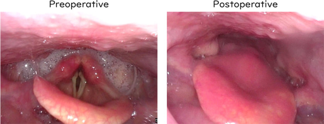Improved Pharyngeal Contraction and Oral Intake Status After Modified Central-Part Laryngectomy for Late-Stage ALS.
