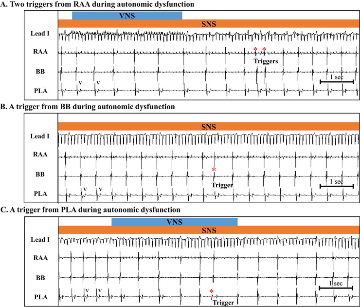 Role of Autonomic Dysfunction in Initiating Postoperative Atrial Fibrillation in a Canine Sterile Pericarditis Model.