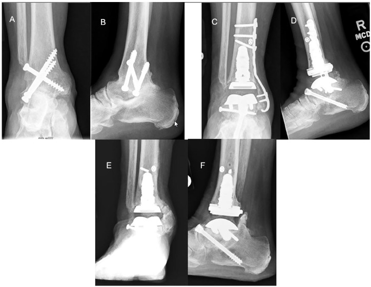 Midterm Outcomes Following Conversion of Failed Ankle Arthrodesis to Total Ankle Arthroplasty, Including Patients With a Deficient Fibula.