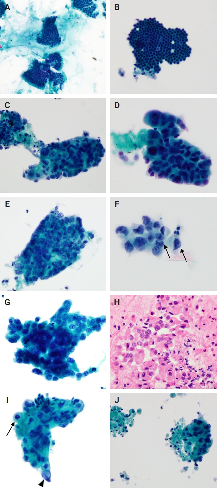 Pancreatic cancer in liquid-based cytology: cytological features and cell block utility from 254 fine-needle aspiration samples.