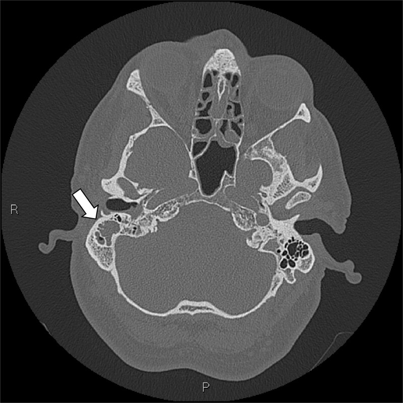 Catastrophic cerebral venous sinus thrombosis secondary to fulminant invasive otomastoiditis.
