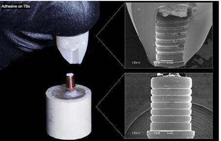 Resin matrix ceramic crowns cemented on titanium bases: effect of surface treatments and stress distribution.