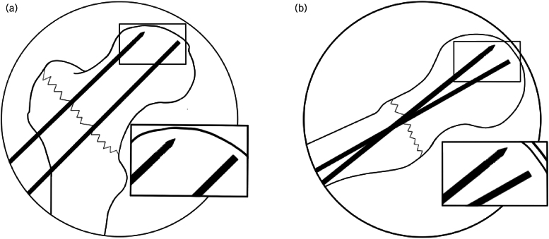 A modified guidewire reinsertion technique following inadvertent wire removal during dynamic hip screw fixation surgery.