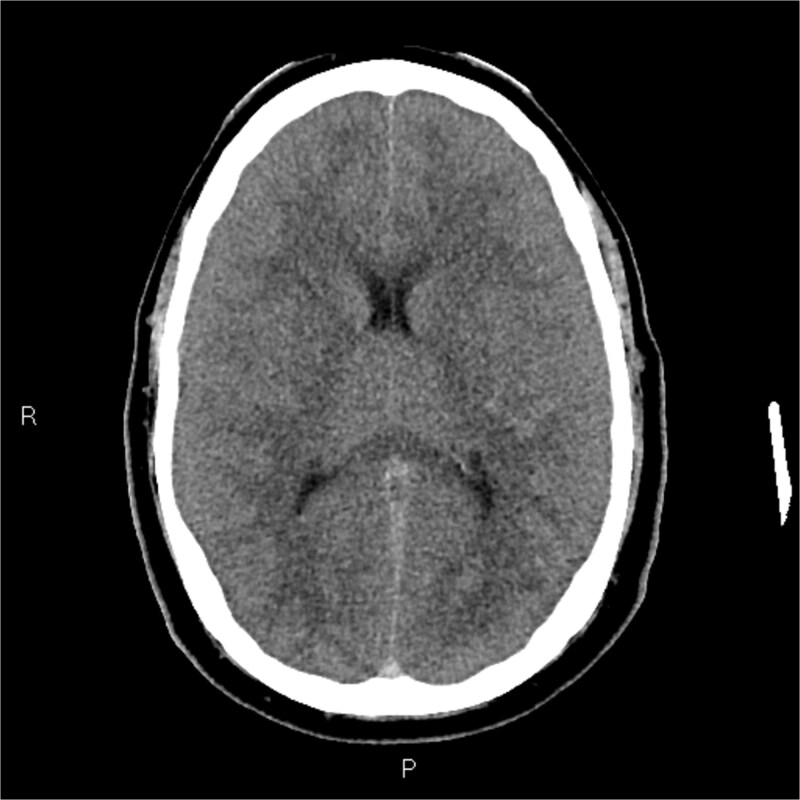 Catastrophic cerebral venous sinus thrombosis secondary to fulminant invasive otomastoiditis.