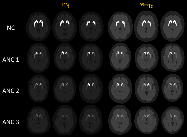 Development of a population of digital brain phantoms for radionuclide imaging research in Parkinson's disease.