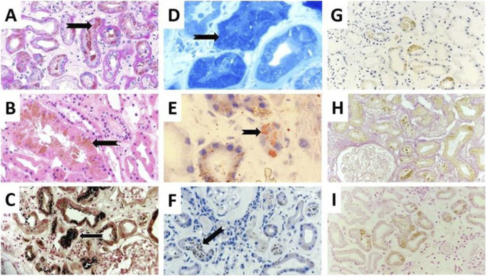 Case Report: Toxic tubulointerstitial nephropathy with lipofuscin deposition - the potential cause of occupational Bisphenol-A exposition.