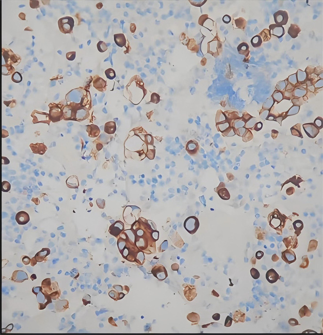 Integrated Traditional Chinese and Western Medicine in Lung Adenocarcinoma with Rare EGFR Mutation and Nephrotic Syndrome: A Case Report.