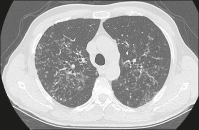Computed tomography findings of pneumonia resistant to empirical therapy in patients with hematologic diseases.