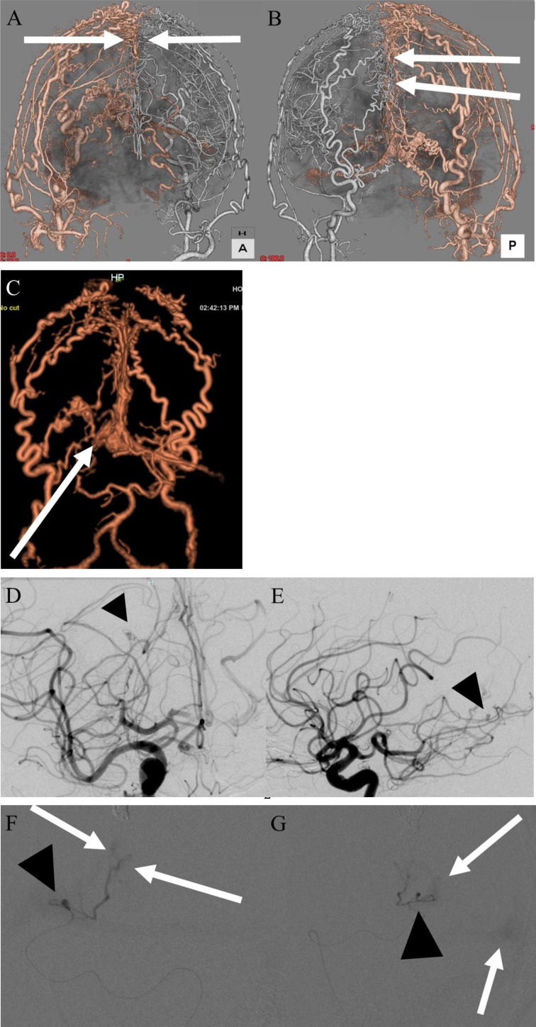 A case of intracranial hemorrhage due to rupture of aneurysm of the distal posterior cerebral artery associated with dural arteriovenous fistulas of the falcine sinus.