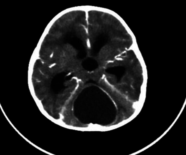Extremely Rare Presentation of Pilonidal Sinus Disease in the Posterior Cranial Fossa of a 2-Year-Old Patient: A Case Report.
