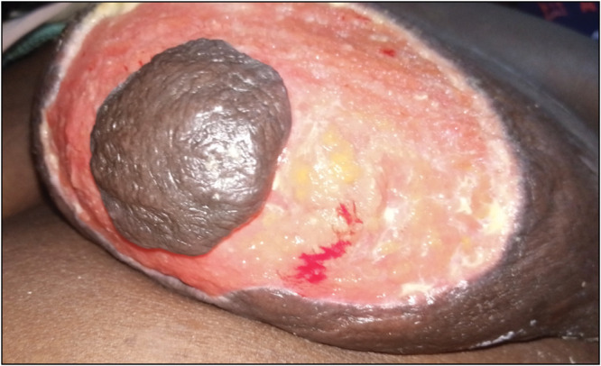 Primary Breast Necrotising Fasciitis in an Elderly Woman Managed with Nipple-Areola Conservation and Delayed Primary Closure in a Resource-Poor Setting A Case Report.