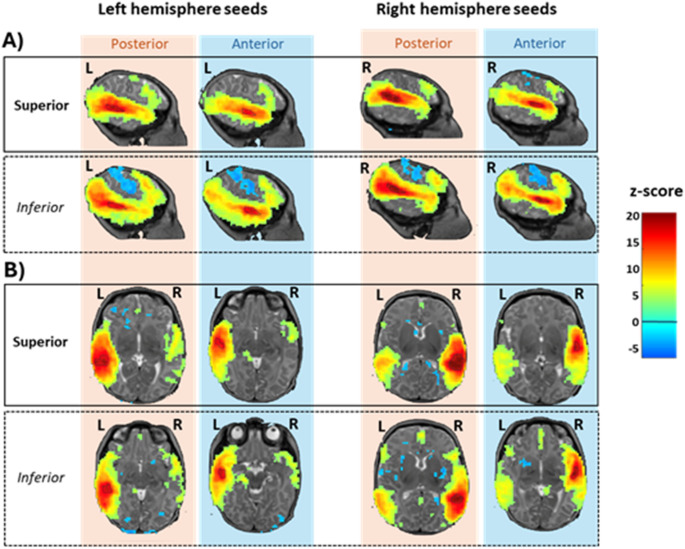 Functional connectivity of the superior temporal sulcus at term-equivalent age: effects of gestational age and sex.